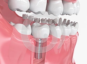 Tooth human implant - 3D Rendering