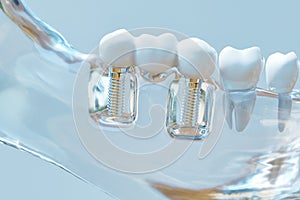 Tooth human implant - 3D Rendering
