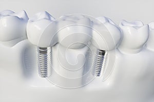 Tooth human implant - 3D Rendering
