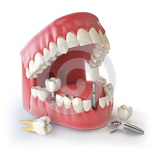 Tooth human implant. Dental concept. Human teeth or dentures.