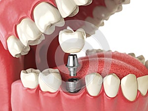 Zub člověk implantát. zubní. člověk zuby nebo umělý chrup 