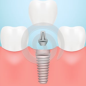 Tooth Human Implant. Dental Concept. Human Teeth Or Dentures Isolated On A Background. Vector Illustration.
