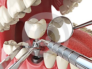 Tooth human implant. Dental implantation concept. Human teeth or