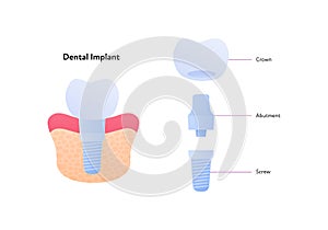 Tooth implant chart. Vector biomedical illustration. Cross section. Teeth prosthesis scheme isolated on white background. Design