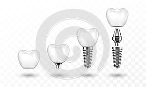 Tooth implant in disassembled form