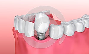 Tooth implant instalation process , Medically accurate 3D illustration