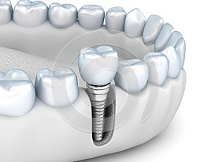 Tooth implant instalation process , Medically accurate 3D illustration