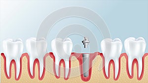 Tooth implant instalation process, Medically accurate 3D illustration white style. 4k motion video.