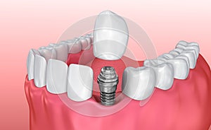 Tooth implant instalation process , Medically accurate 3D illustration photo