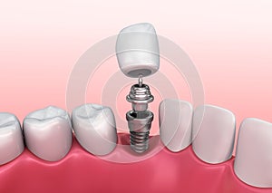 Tooth implant instalation process , Medically accurate 3D illustration photo