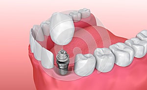 Tooth implant instalation process , Medically accurate 3D illustration photo