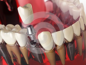 Tooth implant in the model human teeth, gums and denturas. Dental medicine stomatology concept.