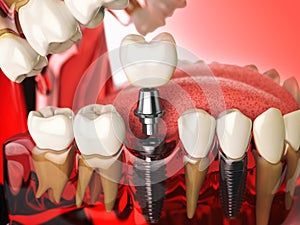 Tooth implant in the model human teeth, gums and denturas. Dental medicine stomatology concept.