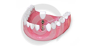 Tooth implant model in jaw 3d illustration