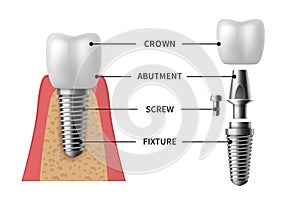 Tooth implant. Realistic implant structure pictorial models crown. Abutment, screw denture orthodontic implantation