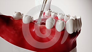 Tooth implantation picture series 2 of 13 - 3D Rendering