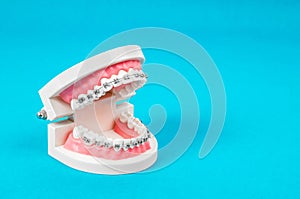 Tooth model with metal wire dental braces