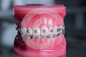 Tooth model with metal wired dental braces