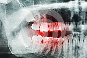 Tooth Pain On X-Ray