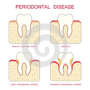 Tooth periodontal disease,