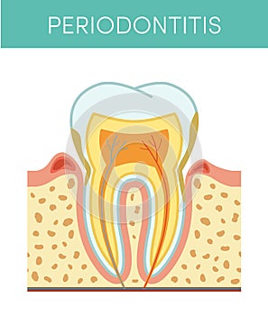 Tooth with periodontitis