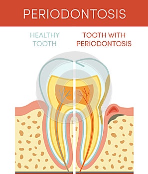 Tooth with periodontosis