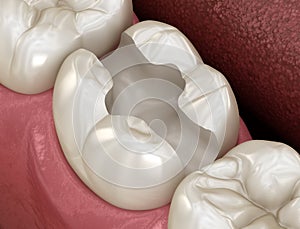 Tooth preparation for inlay placement. Medically accurate 3D illustration of human teeth