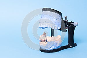 Tooth recovery with implant. Plaster model of teeth. Upper and lower jaws plaster model with prepared teeth. White front