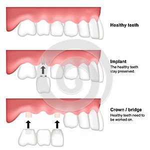 Tooth replacement dental medical vector illustration isolated on white background