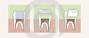 Tooth Restoration with Filling, Ceramic Inlay, Onlay, Flat Vector Stock Illustration with Collage or Banner Set with Canal