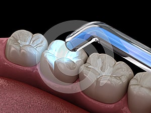 Tooth restoration with filling and polymerization lamp. Medically accurate tooth 3D illustration