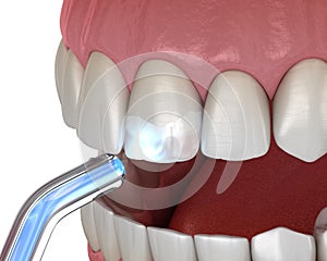 Tooth restoration with filling and polymerization lamp. Medically accurate tooth 3D illustration