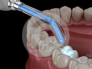 Tooth restoration with filling and polymerization lamp. Medically accurate tooth 3D illustration