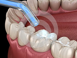 Tooth restoration with filling and polymerization lamp. Medically accurate tooth 3D illustration