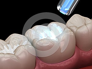 Tooth restoration with filling and polymerization lamp. Medically accurate tooth 3D illustration