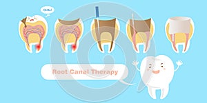 Tooth with root canal therapy