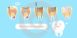 Tooth with root canal therapy photo