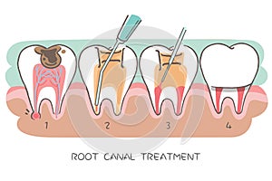 Tooth with root canal treatment