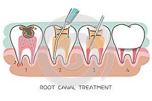 Tooth with root canal treatment photo