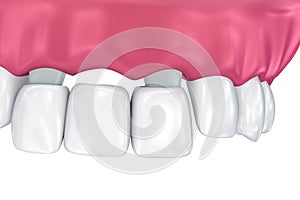 Dente supportato fisso ponte. dal punto di vista medico accurato  tridimensionale illustrazioni 