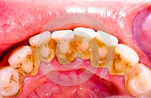 Tooth tartar photo