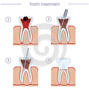Tooth treatment, step by step instructions. Endodanic treatment, modern dentistry. Vector illustration for dental textbooks