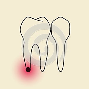Toothache - Pulpitis