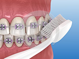 Toothbrush cleaning braces process. Medically accurate 3D illustration of oral hygiene
