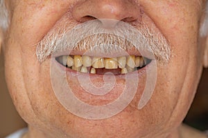Toothless male smile mouth of senior elderly old man, dental problem, bad rotten teeth loss, caries