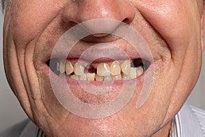 The toothless smile of an old European man on a gray background. Dentistry for pensioners, happy old age, dentist installing