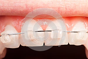 Top tooth alignment with ceramic braces