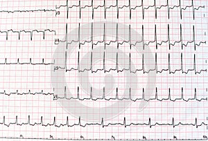 Top view of an electrocardiogram in printed paper form for health care and medical concept or background. EKG or ECG.