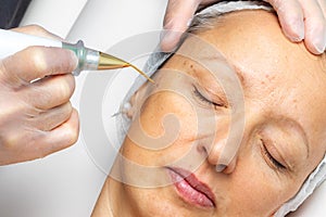 Top view of laser plasma pen removing facial wart on middle aged woman