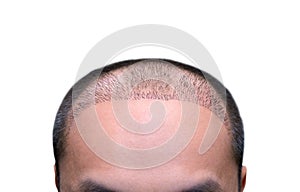 Top view of a man`s head with hair transplant surgery with a receding hair line photo
